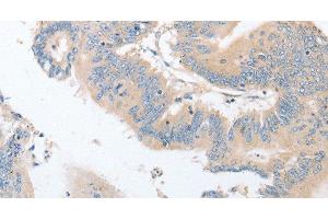 Immunohistochemistry of paraffin-embedded Human colon cancer using EPS15L1 Polyclonal Antibody at dilution of 1:30 (EPS15L1 Antikörper)