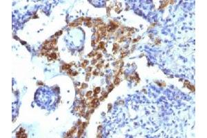 Formalin-fixed, paraffin-embedded human lung adenocarcinoma stained with Napsin-A antibody (NAPSA/1239). (NAPSA Antikörper)