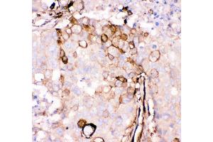 Anti- Gelsolin antibody, IHC(P) IHC(P): Human Mammary Cancer Tissue