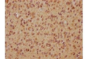 IHC image of ABIN7152257 diluted at 1:560 and staining in paraffin-embedded human glioma cancer performed on a Leica BondTM system. (EXOC7 Antikörper  (AA 521-735))