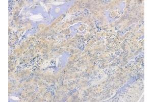 ABIN6264471 and ABIN6278269 at 1/100 staining human lung adenocarcinoma by IHC-P. (PSMA5 Antikörper  (N-Term))