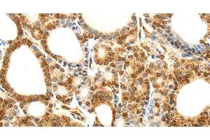 Immunohistochemistry of paraffin-embedded Human thyroid cancer using Otocadherin Polyclonal Antibody at dilution of 1:80 (CDH23 Antikörper)