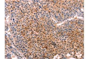 The image on the left is immunohistochemistry of paraffin-embedded Human liver cancer tissue using ABIN7129127(CYP1B1 Antibody) at dilution 1/20, on the right is treated with fusion protein. (CYP1B1 Antikörper)