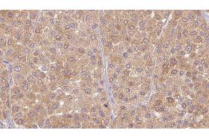 ABIN6277480 at 1/100 staining Human Melanoma tissue by IHC-P. (Neurotrophin 3 Antikörper  (Internal Region))