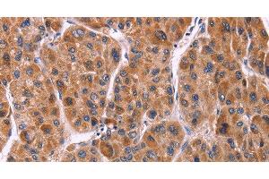 Immunohistochemistry of paraffin-embedded Human liver cancer tissue using Ephrin A5 Polyclonal Antibody at dilution 1:40 (Ephrin A5 Antikörper)