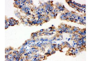 Anti- ALDH2 Picoband antibody, IHC(P) IHC(P): Human Kidney Cancer Tissue (ALDH2 Antikörper  (N-Term))