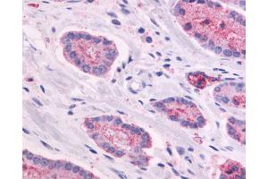 Anti-GPR87 antibody IHC of human Prostate, Carcinoma. (GPR87 Antikörper  (N-Term))