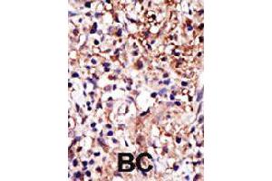 Formalin-fixed and paraffin-embedded human cancer tissue reacted with CAPRIN1 polyclonal antibody  , which was peroxidase-conjugated to the secondary antibody, followed by DAB staining . (Caprin-1 Antikörper  (AA 625-654))
