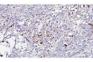 ABIN6277521 at 1/100 staining Human urothelial cancer tissue by IHC-P. (S100A12 Antikörper)