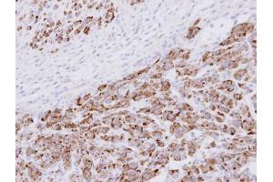 IHC-P Image Immunohistochemical analysis of paraffin-embedded U87 xenograft , using 20S Proteasome alpha3 , antibody at 1:100 dilution.