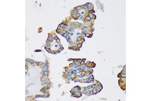 Immunohistochemistry of paraffin-embedded Human thyroid cancer using DYNLRB1 Rabbit pAb (ABIN7266866) at dilution of 1:100 (40x lens).