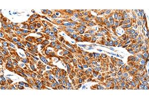 Immunohistochemistry of paraffin-embedded Human esophagus cancer using HSP75 Polyclonal Antibody at dilution of 1:100 (TRAP1 Antikörper)