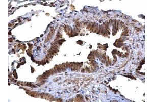 IHC-P Image CD74 antibody [N1N2], N-term detects CD74 protein at cytoplasm on human lung carcinoma by immunohistochemical analysis.
