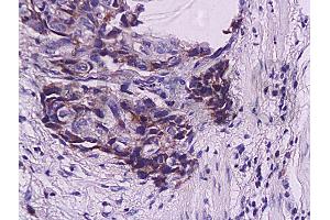 Formalin-fixed and paraffin embedded human esophageal carcinoma labeled with Anti-WIG-1/PAG608 Polyclonal Antibody, Unconjugated (ABIN730108) at 1:200, followed by conjugation to the secondary antibody and DAB staining (ZMAT3 Antikörper  (AA 201-288))