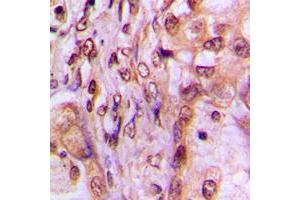 Immunohistochemical analysis of MAF1 staining in human breast cancer formalin fixed paraffin embedded tissue section. (MAF1 Antikörper  (Center))