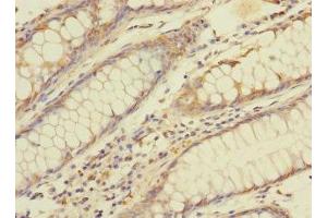 Immunohistochemistry of paraffin-embedded human colon cancer using ABIN7145902 at dilution of 1:100 (BTNL3 Antikörper  (AA 18-237))