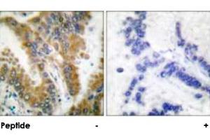 Immunohistochemical analysis of paraffin-embedded human lung carcinoma tissue, using CRKL polyclonal antibody . (CrkL Antikörper)