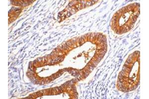 Immunohistochemistry (IHC) image for anti-Carcinoembryonic Antigen Gene Family (CEA) antibody (ABIN3181131) (CEA Antikörper)