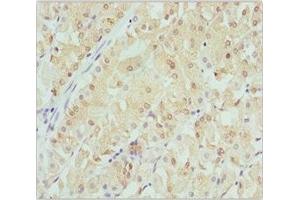 Immunohistochemistry of paraffin-embedded human gastric cancer using ABIN7145471 at dilution of 1:100 (CRYGS Antikörper  (AA 1-178))