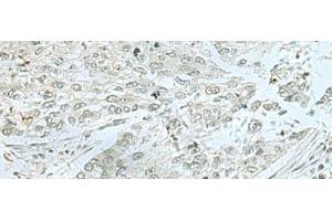 Immunohistochemistry of paraffin-embedded Human lung cancer tissue using THTPA Polyclonal Antibody at dilution of 1:70(x200) (THTPA Antikörper)