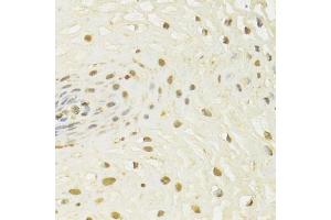 Immunohistochemistry of paraffin-embedded human esophageal cancer using HDAC3 Antibody. (HDAC3 Antikörper)