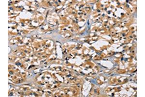 The image on the left is immunohistochemistry of paraffin-embedded Human thyroid cancer tissue using ABIN7130690(PPP3CA Antibody) at dilution 1/30, on the right is treated with fusion protein. (PPP3CA Antikörper)