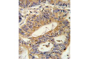 Formalin-fixed and paraffin-embedded human colon carcinoma reacted with IL17RB Antibody (Center), which was peroxidase-conjugated to the secondary antibody, followed by DAB staining. (IL17 Receptor B Antikörper  (AA 207-234))