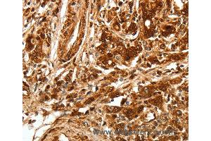Immunohistochemistry of Human gastic cancer using TGFBR1 Polyclonal Antibody at dilution of 1:70