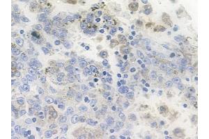 ABIN6255870 and ABIN6267134 at 1/100 staining human melanoma by IHC-P.