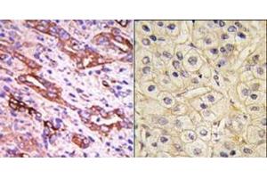 (LEFT)Formalin-fixed and paraffin-embedded human cancer tissue reacted with the primary antibody, which was peroxidase-conjugated to the secondary antibody, followed by DAB staining. (GRK1 Antikörper  (C-Term))