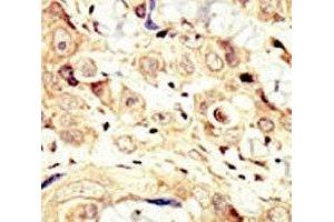 IHC analysis of FFPE human breast carcinoma tissue stained with the HER4 antibody (ERBB4 Antikörper  (AA 25-55))