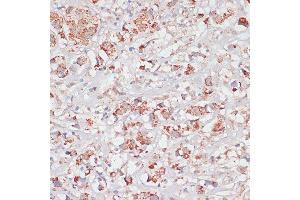 Immunohistochemistry of paraffin-embedded Human breast cancer using Desmoplakin antibody (ABIN6134106, ABIN6139838, ABIN6139840 and ABIN6223548) at dilution of 1:100 (40x lens).