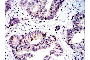 Immunohistochemistry (IHC) image for anti-Baculoviral IAP Repeat-Containing 5 (BIRC5) antibody (ABIN1845166) (Survivin Antikörper)