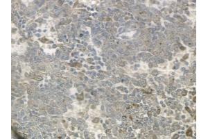 ABIN6259318 and ABIN6274720 at 1/100 staining human melanoma by IHC-P. (MRPS18C Antikörper  (Internal Region))
