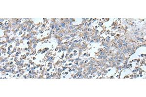 Immunohistochemistry of paraffin-embedded Human tonsil tissue using IRF5 Polyclonal Antibody at dilution of 1:25(x200)