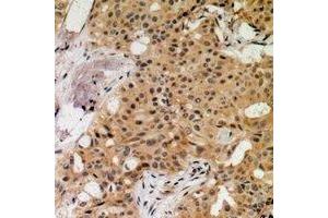 Immunohistochemical analysis of MNK1 (pT250) staining in human breast cancer formalin fixed paraffin embedded tissue section. (MKNK1 Antikörper  (pSer250))