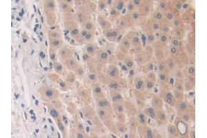 IHC-P analysis of Human Liver cancer Tissue, with DAB staining. (PLA2G10 Antikörper  (AA 32-165))