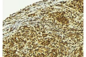 ABIN6279170 at 1/100 staining Human breast cancer tissue by IHC-P. (PIF1 Antikörper  (Internal Region))