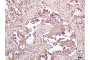 Formalin-fixed and paraffin embedded human lung carcinoma labeled with Rabbit Anti HSP10/CPN10 Polyclonal Antibody, Unconjugated (ABIN721885) at 1:200 followed by conjugation to the secondary antibody and DAB staining (HSPE1 Antikörper  (AA 51-102))