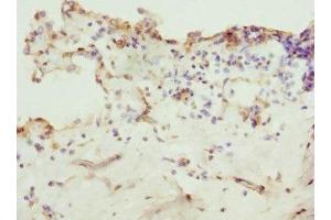 Immunohistochemistry of paraffin-embedded human breast cancer using ABIN7176368 at dilution of 1:100 (ZNF549 Antikörper  (AA 1-280))
