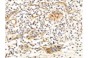 ABIN6260575 and ABIN6268769 at 1/100 staining Human pancreatic cancer by IHC-P. (CD147 Antikörper  (C-Term))