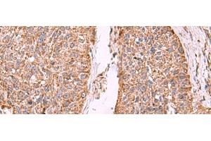 Immunohistochemistry of paraffin-embedded Human esophagus cancer tissue using PER3 Polyclonal Antibody at dilution of 1:55(x200) (PER3 Antikörper)