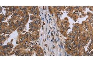 Immunohistochemistry of paraffin-embedded Human ovarian cancer using NDUFAF4 Polyclonal Antibody at dilution of 1:45 (NDUFAF4 Antikörper)