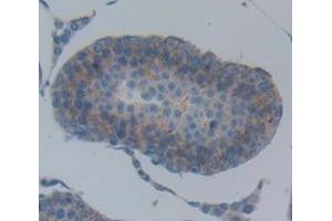 Immunohistochemistry (IHC) image for anti-Cadherin 1, Type 1, E-Cadherin (Epithelial) (CDH1) (AA 374-628) antibody (ABIN1858333)