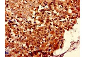 Immunohistochemistry of paraffin-embedded human breast cancer using ABIN7149126 at dilution of 1:100 (UBXN11 Antikörper  (AA 38-146))