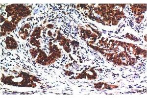 Immunohistochemistry of paraffin-embedded Human breast carcinoma tissue using AKT1 Monoclonal Antibody at dilution of 1:200. (AKT1 Antikörper)