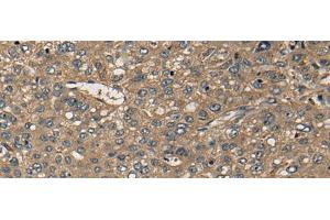 Immunohistochemistry of paraffin-embedded Human liver cancer tissue using CD1B Polyclonal Antibody at dilution of 1:55(x200) (CD1b Antikörper)