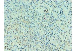 Immunohistochemistry of paraffin-embedded human breast cancer using ABIN7161130 at dilution of 1:100 (NEDD8 Antikörper  (AA 1-81))