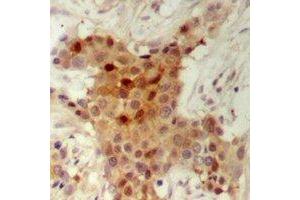 Immunohistochemical analysis of HER2 staining in human breast cancer formalin fixed paraffin embedded tissue section. (ErbB2/Her2 Antikörper  (C-Term))