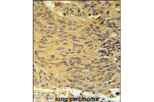 LCLT1 Antibody immunohistochemistry analysis in formalin fixed and paraffin embedded human lung carcinoma followed by peroxidase conjugation of the secondary antibody and DAB staining. (LCLAT1 Antikörper  (C-Term))